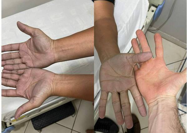 Tenía las manos azuladas, fue a urgencias y era solo culpa del jeans