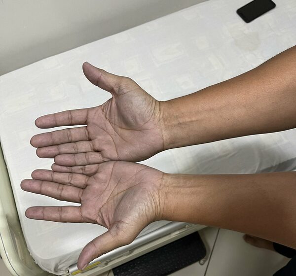 Diario HOY | Sustos que dan gusto: fue al hospital porque tenía las manos azules, la razón fue simpática