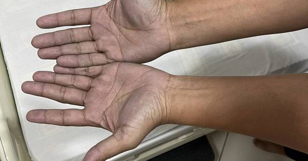 La Nación / Viral: fue desesperado al hospital porque sus manos estaban azules, pero era mancha de su jeans