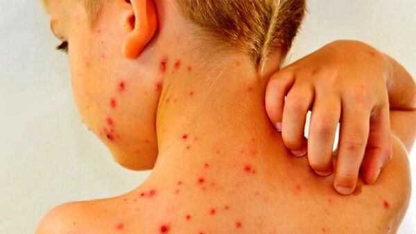 Sarampión: Alertan sobre brotes por los migrantes antivacunas
