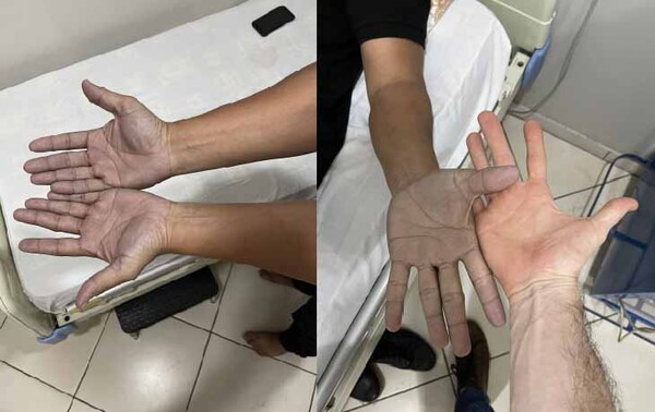 Sustos que dan gusto: fue al hospital porque tenía las manos azules, la razón fue simpática – Prensa 5