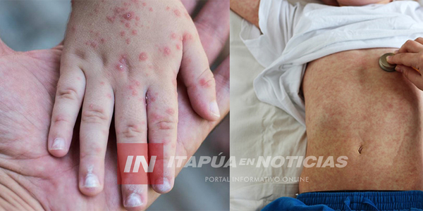 SARAMPIÓN NO CUENTA CON TRATAMIENTO ESPECÍFICO EXCEPTO LA VACUNACIÓN - Itapúa Noticias