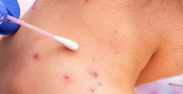Salud reporta primer caso de viruela del mono en sexo femenino y es de Central
