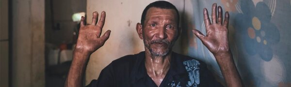 La lepra vuelve - El Independiente