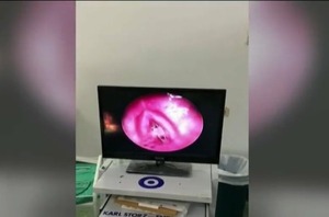 Diario HOY | Médicos salvan a beba de 1 año que tragó vértebras de un pescado