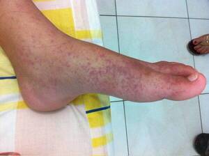 Chikungunya: ¿Qué hacer para aliviar las erupciones en la piel?