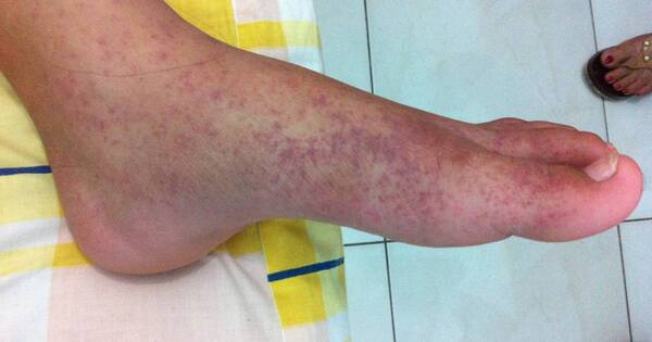 La Nación / Médico brinda recomendaciones para aliviar las erupciones en la piel por chikungunya