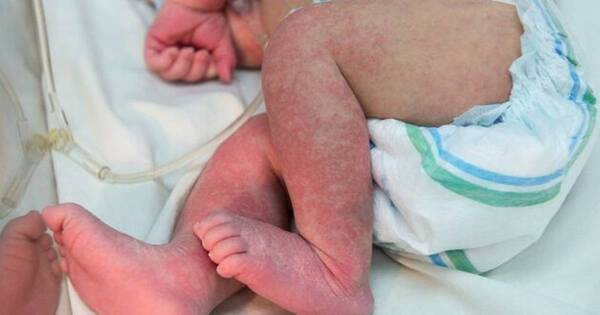 La Nación / Médico insta a llevar a niños al hospital ante síntomas