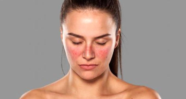 Organizan seminario internacional sobre lupus
