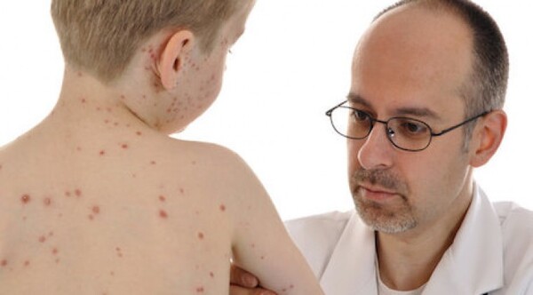 Descartan casos sospechosos de sarampión