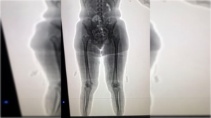 ¡Quelle folie! Quisieron ir a Francia con kilos de merca pegados al cuerpo