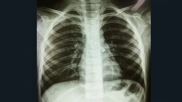 Niño tosió durante tres meses, tenía un resorte en el pulmón - Noticiero Paraguay