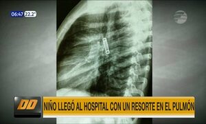 Niño llegó al hospital con un resorte en el pulmón | Telefuturo