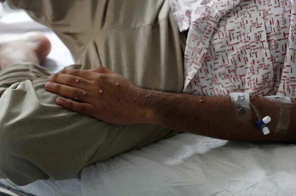 Viruela del mono: más de 100 casos ya se confirmaron en Paraguay - Nacionales - ABC Color