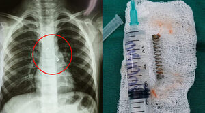 Niño sufría tos sin parar desde hace 3 meses: le descubrieron un resorte en el bronquio - Radio Imperio