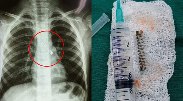 Niño sufría tos sin parar desde hace 3 meses: le descubrieron un resorte en el bronquio - Radio Imperio
