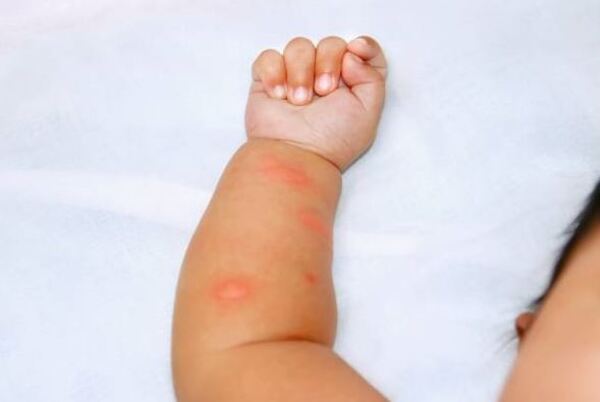 Bebé de un año muere por chikungunya - La Clave