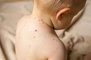 Establecen diferencias entre síntomas de chikunguña y los del sarampión - Nacionales - ABC Color