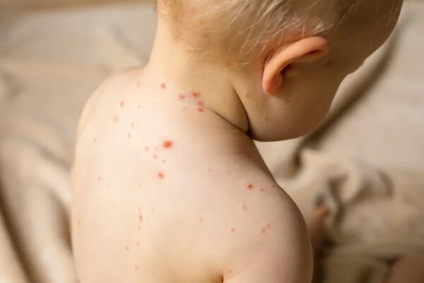 Establecen diferencias entre síntomas de chikunguña y los del sarampión - Nacionales - ABC Color