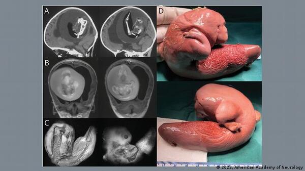 Diario HOY | Feto en feto: médicos extraen “gemelo parásito” del cerebro de una niña de 1 año