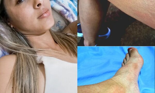 La chikungunya dejó “machucada” a atleta sexy