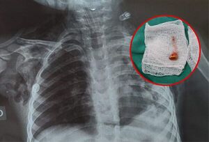 El insólito caso del niño de 3 años que tuvo chikungunya, un maíz en el pulmón y sobrevivió a dos paros cardiacos - Megacadena — Últimas Noticias de Paraguay