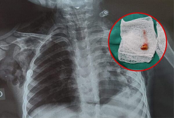 El insólito caso del niño de 3 años que tuvo chikungunya, un maíz en el pulmón y sobrevivió a dos paros cardiacos - Megacadena — Últimas Noticias de Paraguay