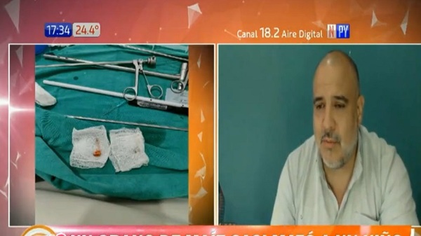 Grano de maíz casi mata a niño de 3 años - Noticias Paraguay