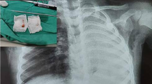 Niño de 3 años sobrevivió a dos paros, al chikungunya y maíz en el pulmón - Noticiero Paraguay