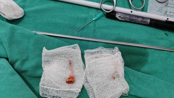 Niño de tres años casi muere al tragar grano de maíz