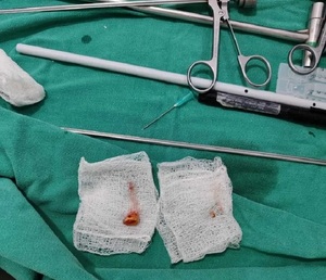 Grano de maíz casi mata a niño de 3 años - Noticias Paraguay
