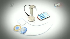 Implante coclear: Un dispositivo que cambia la vida - SNT