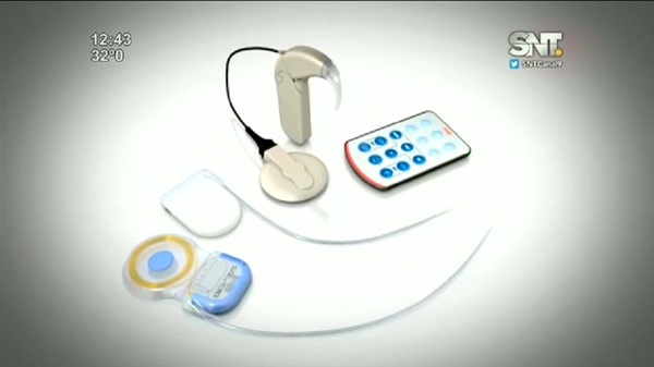 Implante coclear: Un dispositivo que cambia la vida - SNT