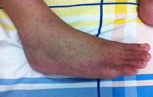 Casos de chikungunya llegan a 4.000 casos por semana