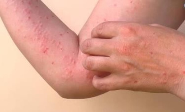 Embarazadas y recién nacidos: Piden extremar cuidados por Chikungunya
