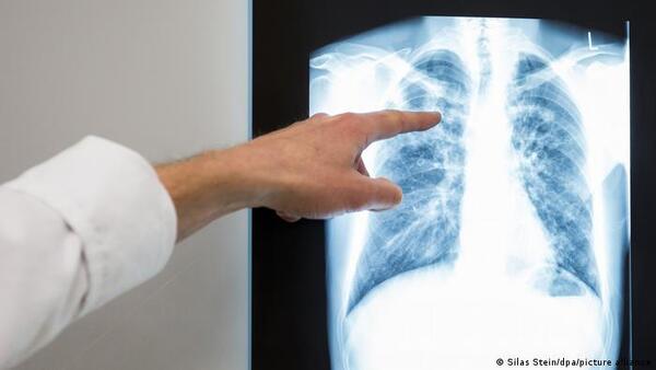 OMS advierte sobre un aumento de casos de tuberculosis en Europa