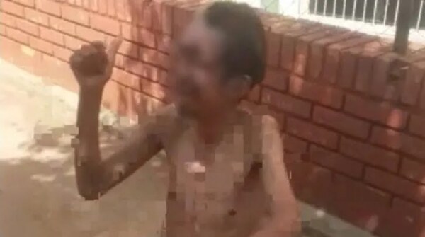 Hombre necesita trasplante de piel por infección agusanada - Noticiero Paraguay