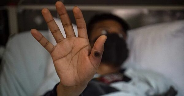 Viruela del mono: Paraguay suma 119 casos en siete meses - Nacionales - ABC Color