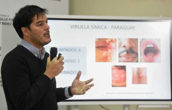 Viruela del mono: anuncian primera infección en Presidente Hayes y suman 119 casos