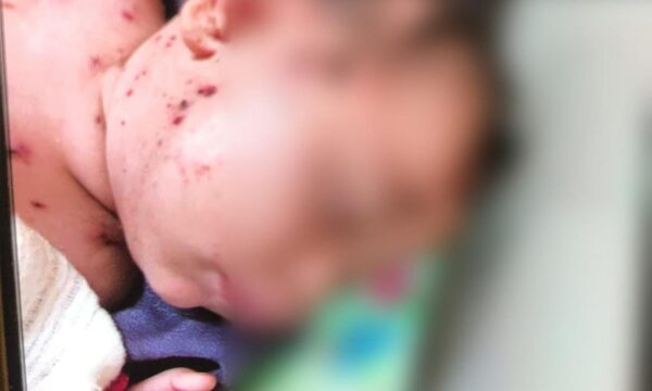 Chikungunya con grave afectación en recién nacidos y piden a embarazadas reforzar cuidados