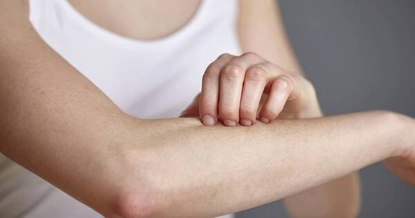 La Nación / Chikungunya: tratamiento para la caída de cabello y descamación de la piel