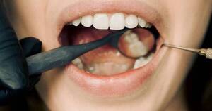 La Nación / Una buena higiene dental previene la aparición del sarro
