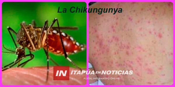 CHIKUNGUNYA: SEPA LOS SIGNOS DE ALARMA QUE INDICAN LA NECESIDAD DE ATENCIÓN MÉDICA URGENTE - Itapúa Noticias