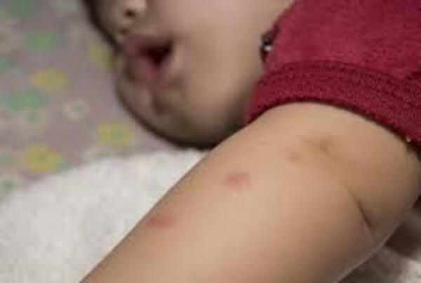Chikungunya: médicos urgen más camas de terapia intensiva para niños