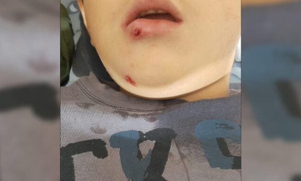 Itapúa: Niño pierde varios dientes tras recibir dos balas perdidas - OviedoPress