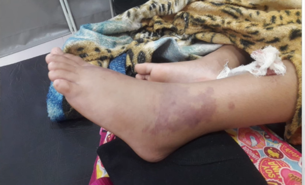 Internan a una nena de 9 años por picadura de una raya