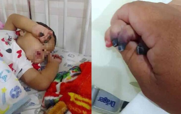 Amputarán 4 deditos a una beba – Prensa 5