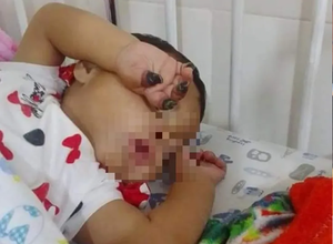 Le amputarán 4 deditos a una beba por supuesta negligencia médica - Noticiero Paraguay