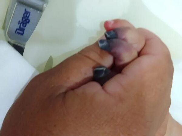 Inician investigación sobre atención a beba a la que le amputarán cuatro dedos de la mano - ABC en el Este - ABC Color