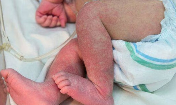 Son nueve los bebés internados en terapia por chikungunya en el Hospital “Acosta Ñu” - OviedoPress